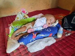 Bayi 3 Bulan di Sidoarjo Derita Penyakit Langka Spina Bifida
